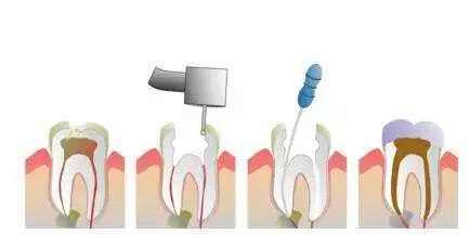 一组动图让你看懂根管治疗！