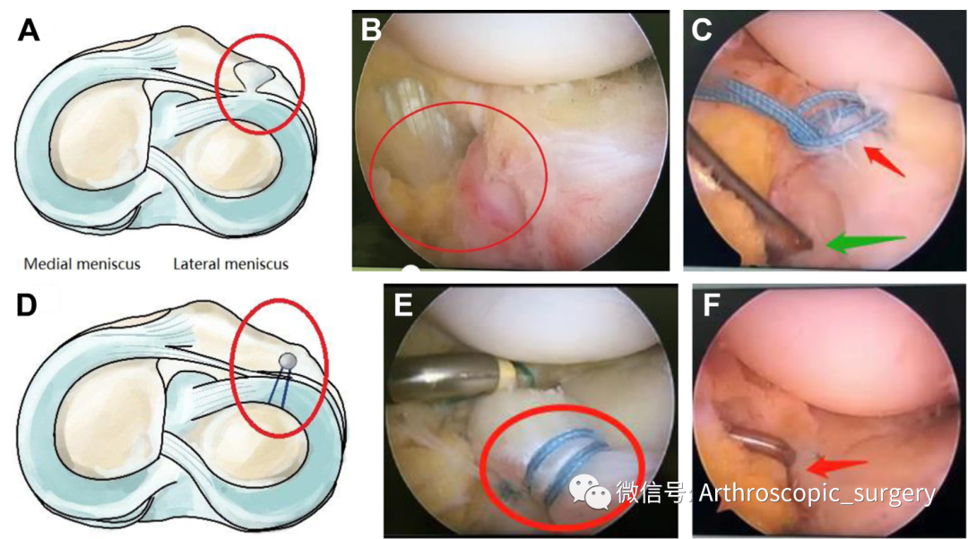 【手术技术】完美外侧半月板前角是如何练成的？