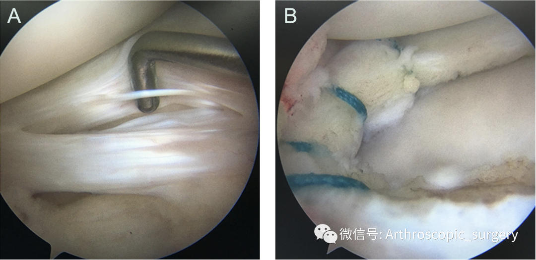 【手术技术】完美外侧半月板前角是如何练成的？