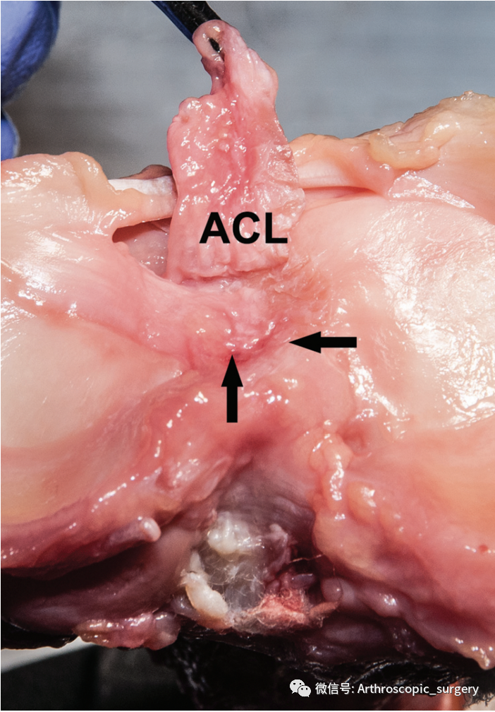 【手术技术】完美外侧半月板前角是如何练成的？