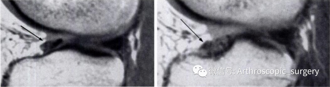 【手术技术】完美外侧半月板前角是如何练成的？