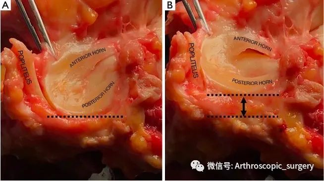 【手术技术】完美外侧半月板前角是如何练成的？