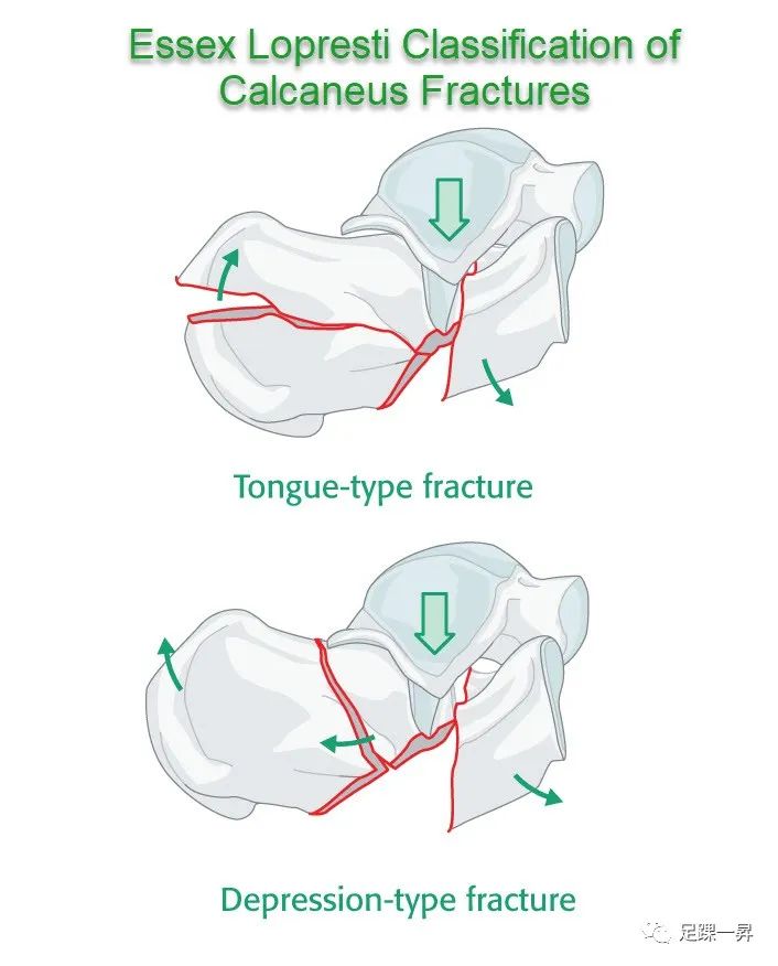 JOT：高能量舌型跟骨骨折的分期治疗
