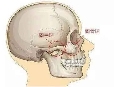 关于颧骨整形你了解多少？