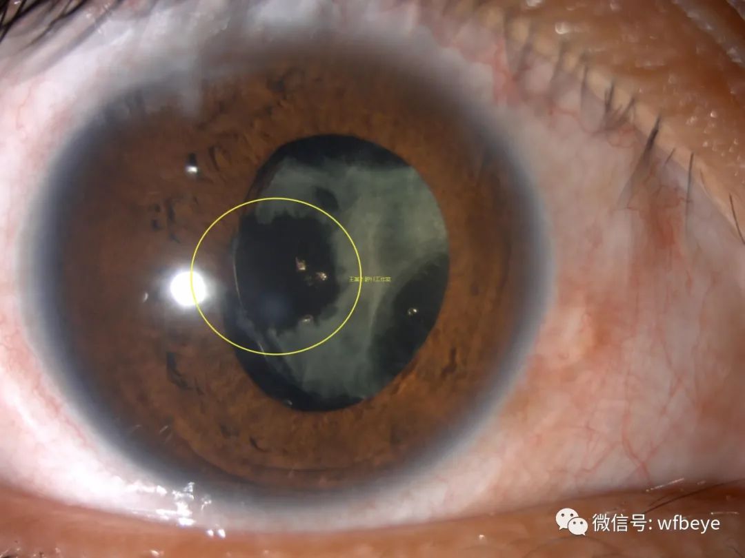 特殊情况下：人工晶体瞳孔嵌顿、瞳孔偏位粘连、后囊膜混浊的激光处理