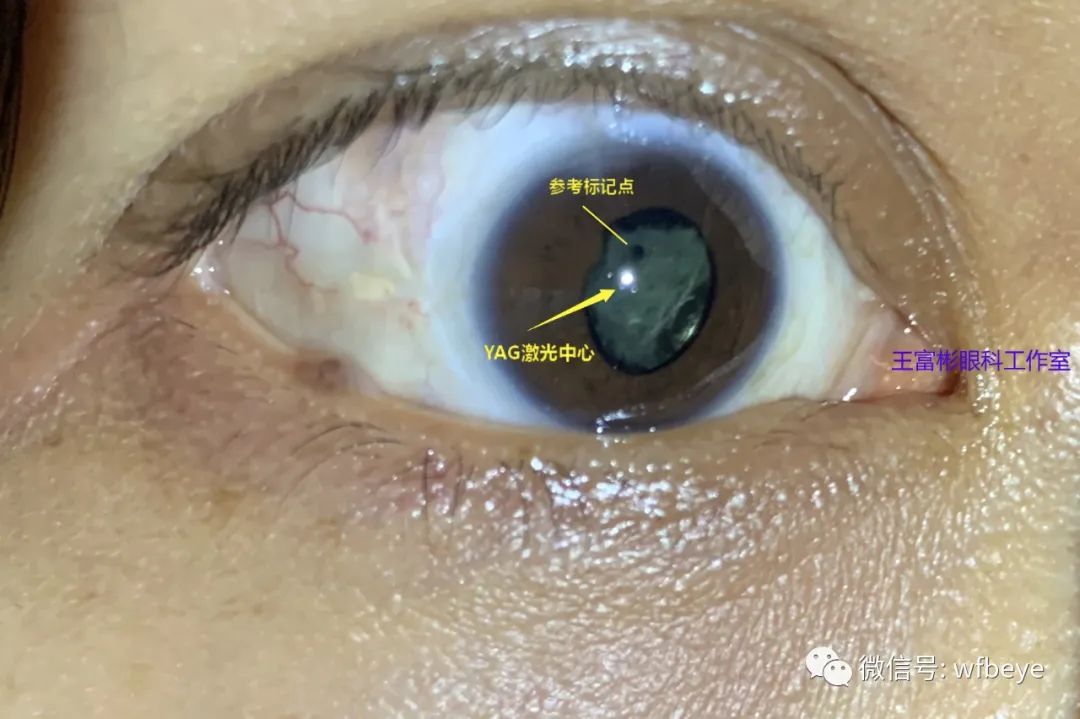 特殊情况下：人工晶体瞳孔嵌顿、瞳孔偏位粘连、后囊膜混浊的激光处理