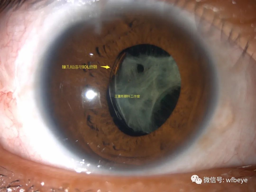 特殊情况下：人工晶体瞳孔嵌顿、瞳孔偏位粘连、后囊膜混浊的激光处理