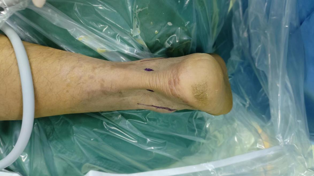 关节镜下踝源性拇长屈肌腱囊肿切除的病例分享