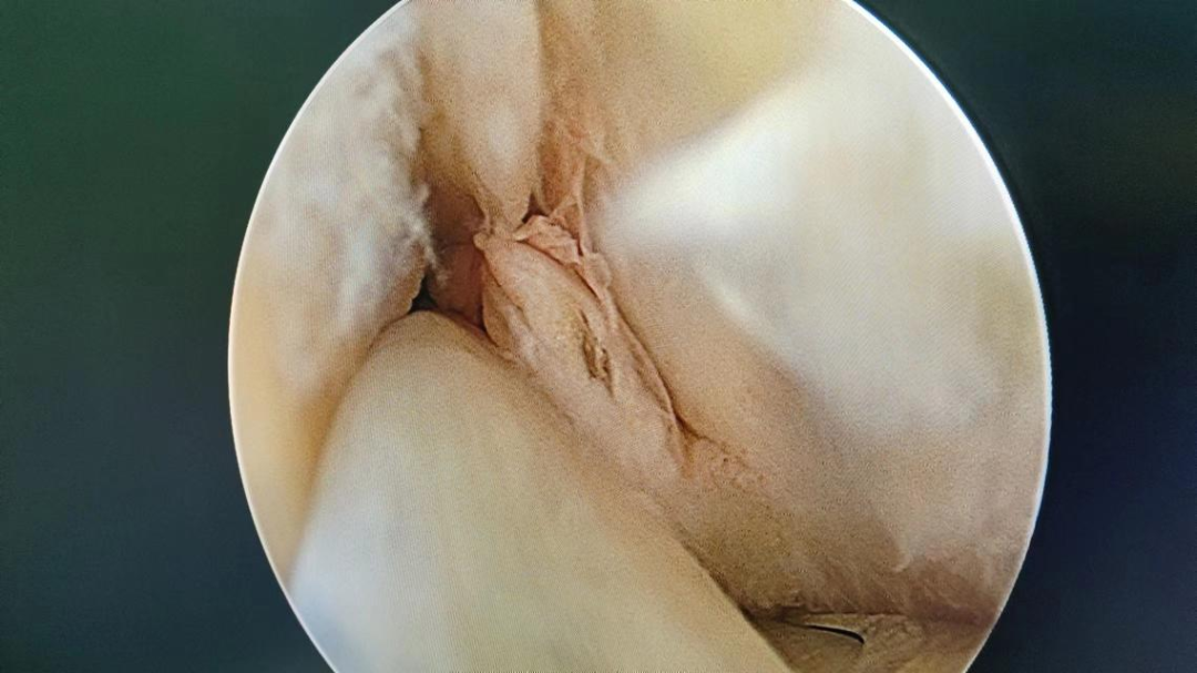 关节镜下踝源性拇长屈肌腱囊肿切除的病例分享