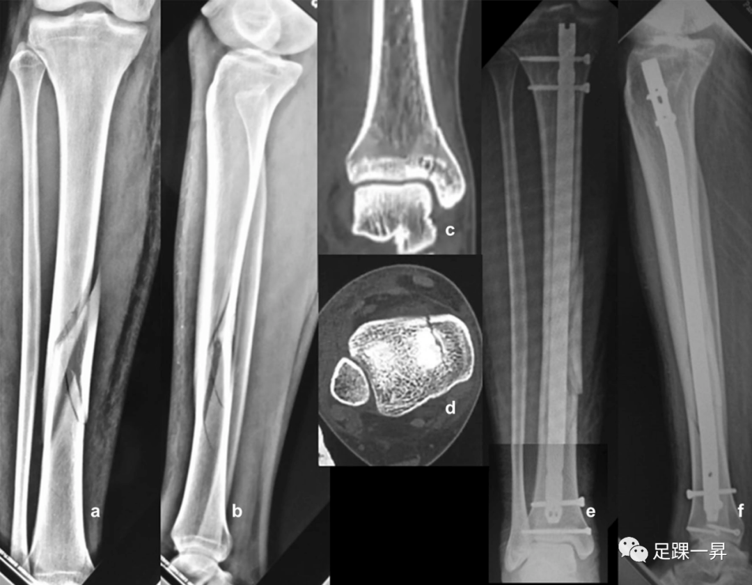 【足踝影像】胫骨干骨折倾斜角、骨折远端至胫骨关节面距离对后踝骨折的意义