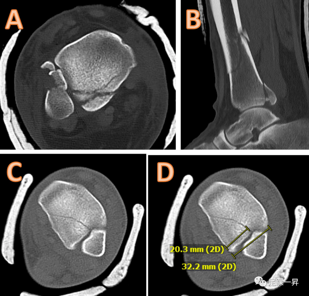 【足踝影像】胫骨干骨折倾斜角、骨折远端至胫骨关节面距离对后踝骨折的意义
