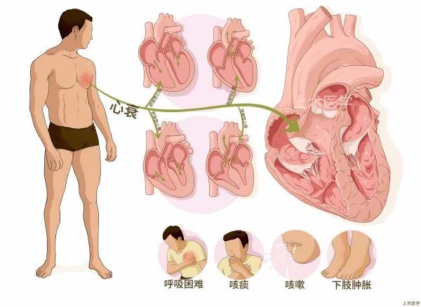 心衰「新四联」用药顺序怎么定？有关心衰治疗的