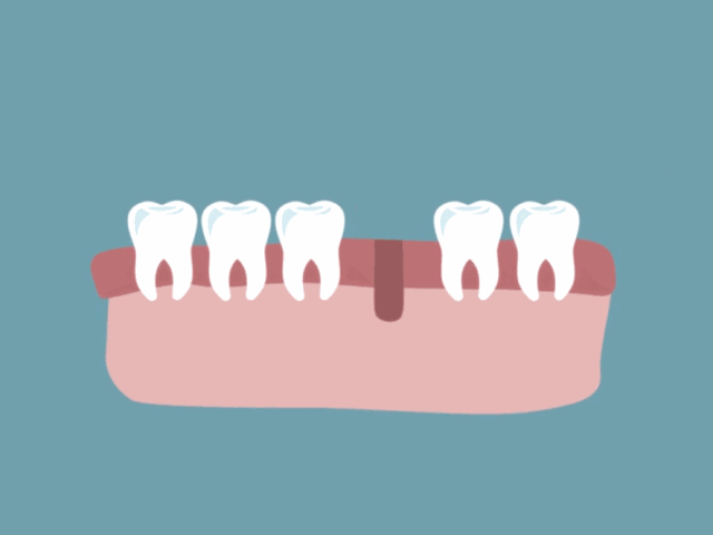 史上最详细的种植牙流程