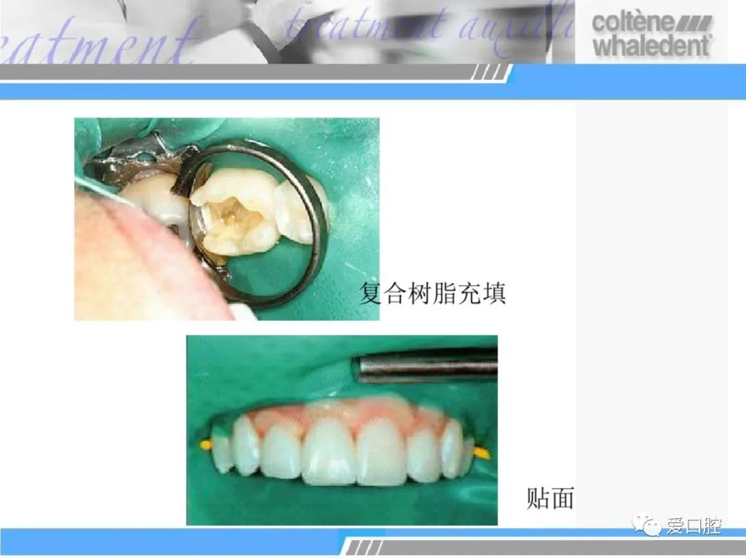 口腔科橡皮障详细使用方法