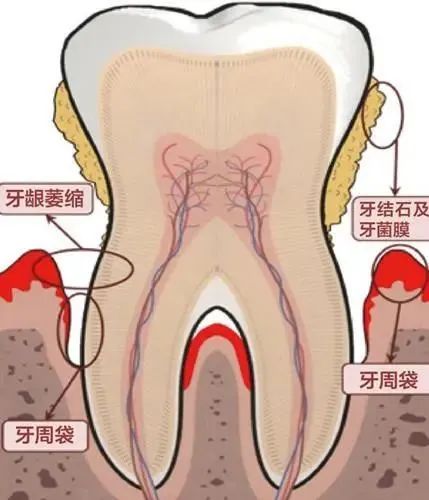 牙龈炎和牙周炎只有一字之差，区别竟然这么大！