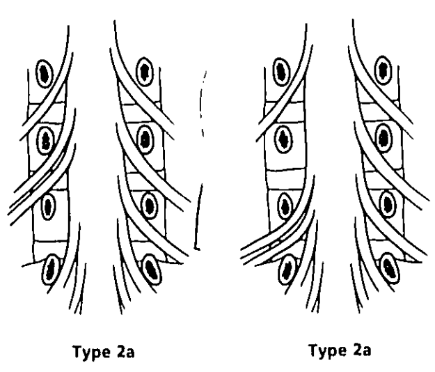 【经典文献】腰椎神经根变异的Neidre分型（附手绘图）