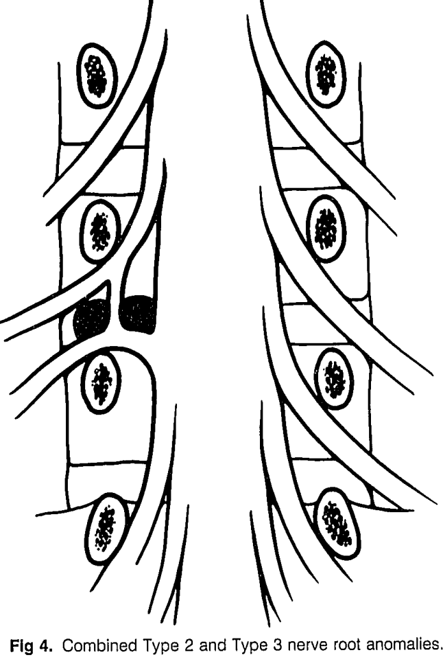 【经典文献】腰椎神经根变异的Neidre分型（附手绘图）