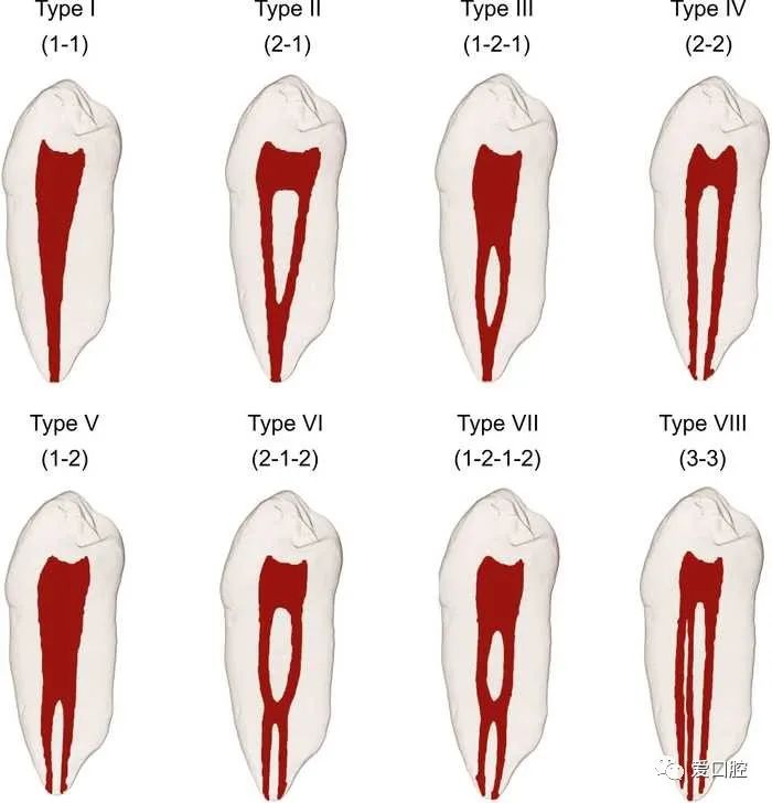 根管形态Vertucci分类法