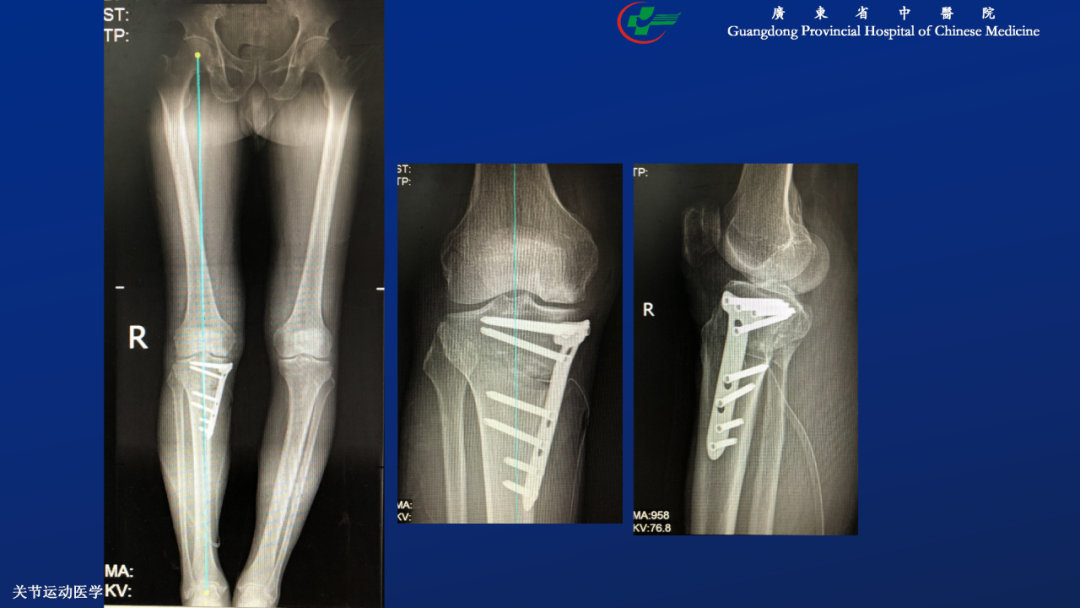 膝关节股骨内侧髁自发性骨坏死的阶梯治疗