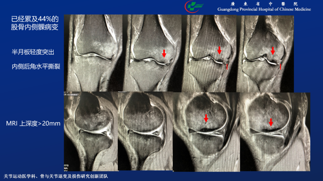 膝关节股骨内侧髁自发性骨坏死的阶梯治疗