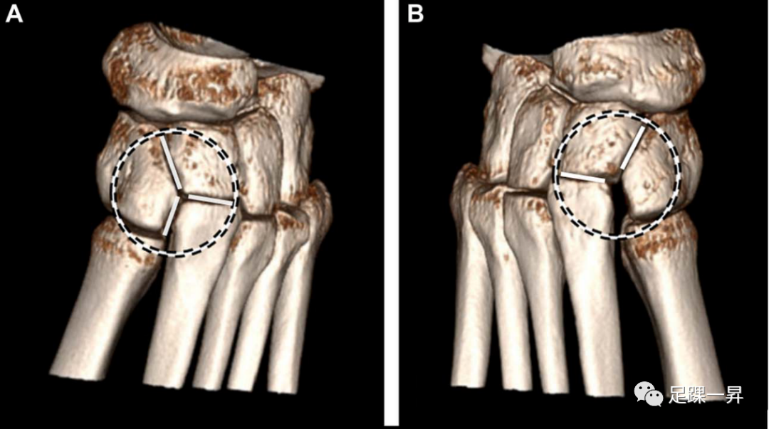 Lisfranc损伤三维CT重建影像学诊断新征象