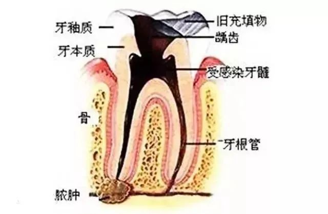 收藏！牙髓息肉的治疗方法，有图有真相