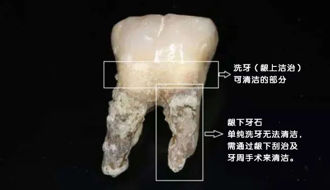 龈下刮治是如何操作的？