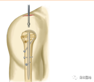【手术技巧】一文介绍肱骨干骨折顺行、逆行髓内钉手术方法及注意事项