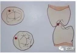 牙医必须掌握的咬合分析