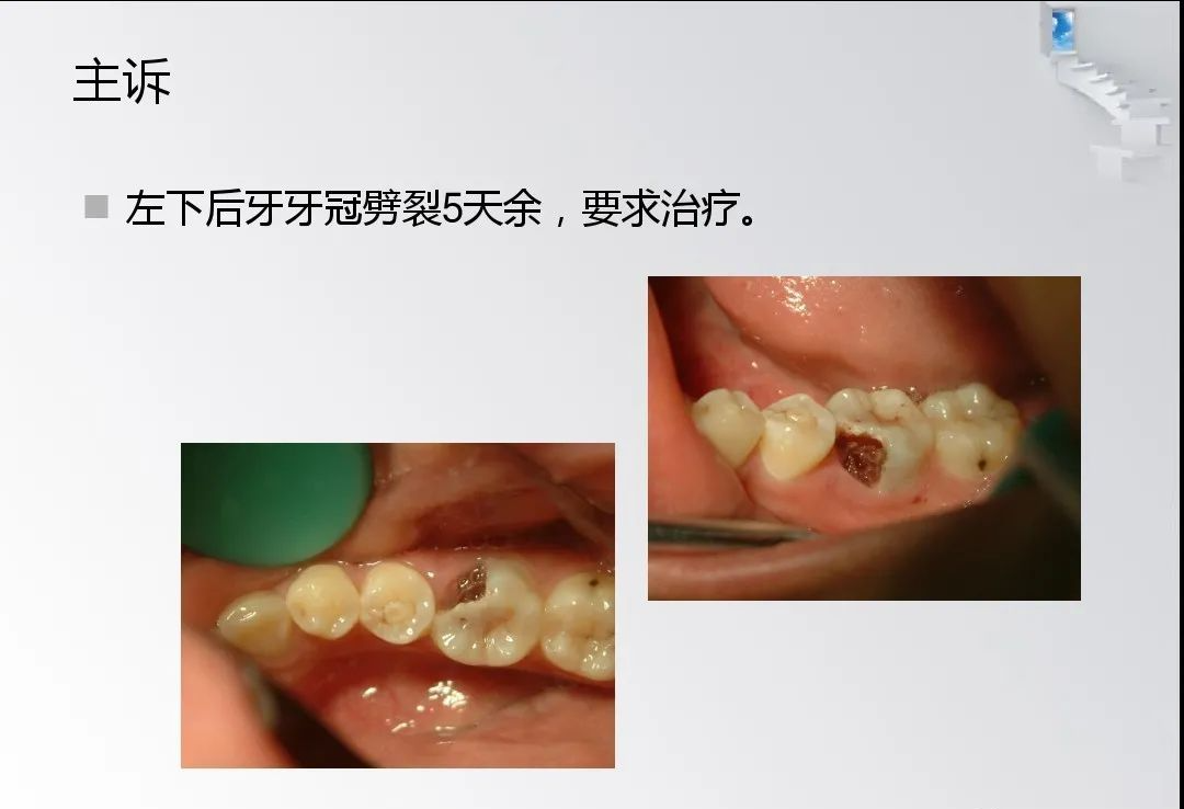 龈切术与冠延长术