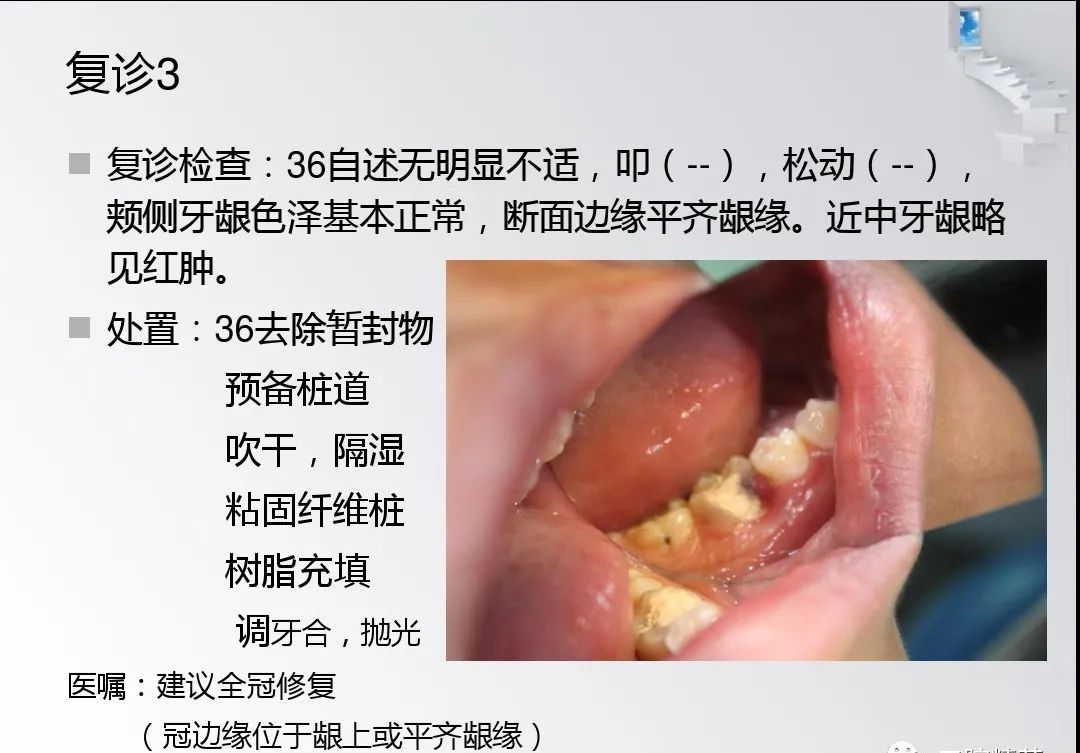 龈切术与冠延长术