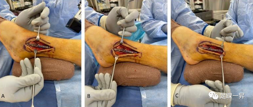【手术技巧】外踝骨折钢板螺钉固定顺序预防复位丢失