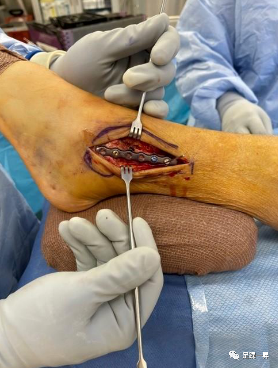 【手术技巧】外踝骨折钢板螺钉固定顺序预防复位丢失