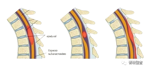 【病例分享】颈肩疼痛以为肩周炎，检查发现板栗大肿瘤！