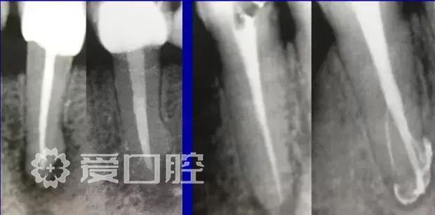 根管治疗应该注意的细节总结