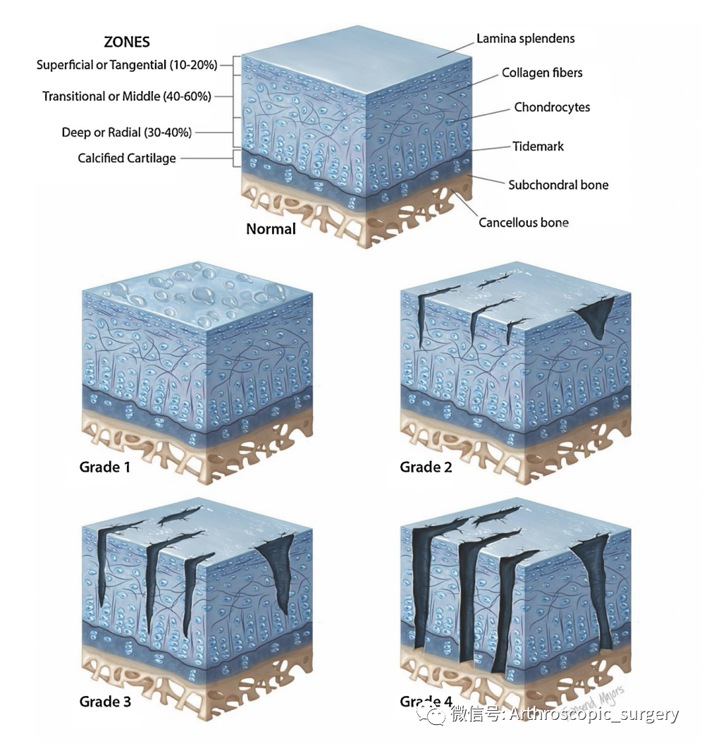 【手术技术】关节镜下软骨的微骨折处理，你真的会吗？