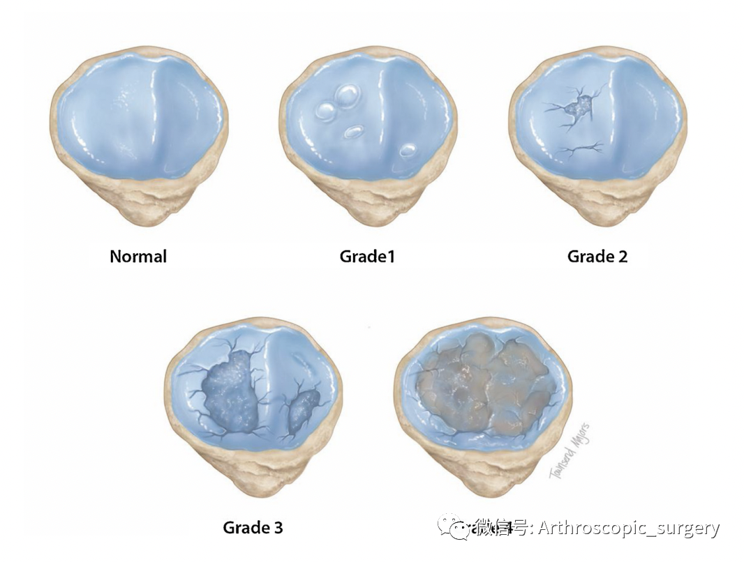 【手术技术】关节镜下软骨的微骨折处理，你真的会吗？