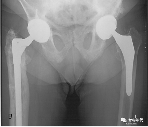 全髋关节置换术治疗继发性Paget‘s病骨关节炎
