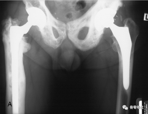全髋关节置换术治疗继发性Paget‘s病骨关节炎