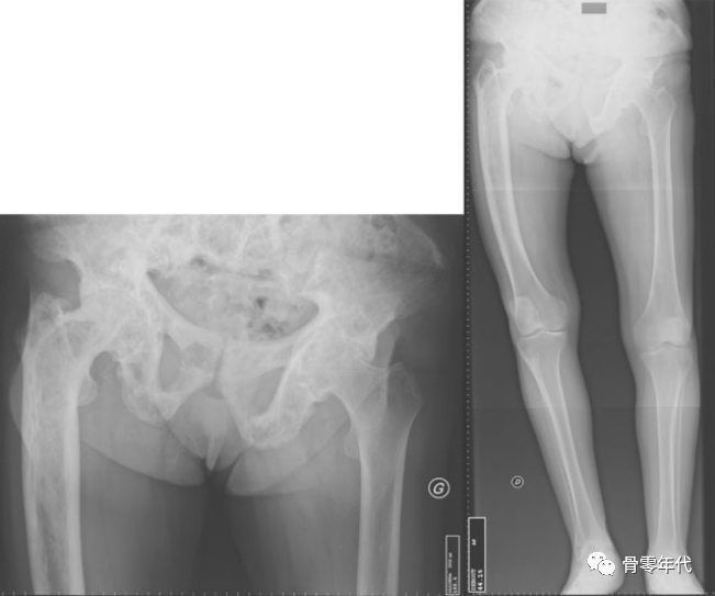 全髋关节置换术治疗继发性Paget‘s病骨关节炎