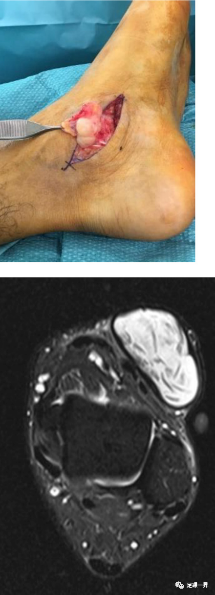 综述：足踝部的良性肿瘤