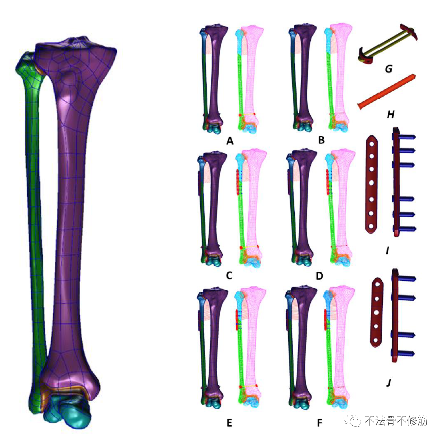 特殊踝骨折——腓骨高位骨折真的不需要固定吗？