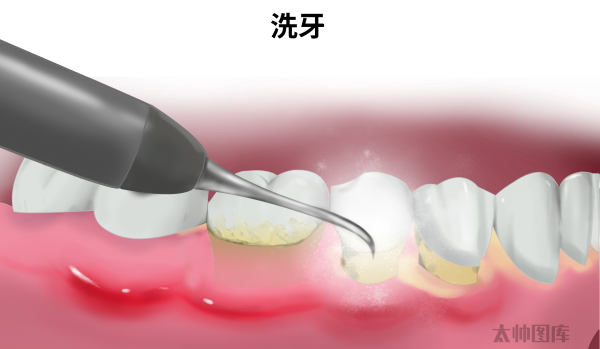 龈下结石，口腔中的隐形炸弹！