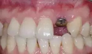 史上最全的种植牙全过程介绍！