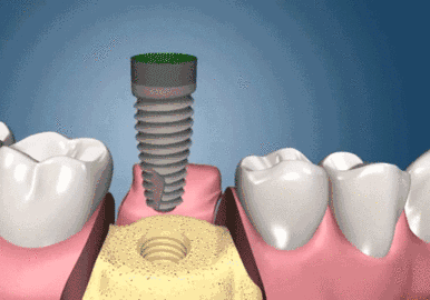 史上最全的种植牙全过程介绍！