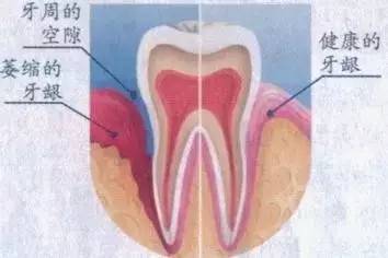牙龈萎缩不可逆，好防不好治！