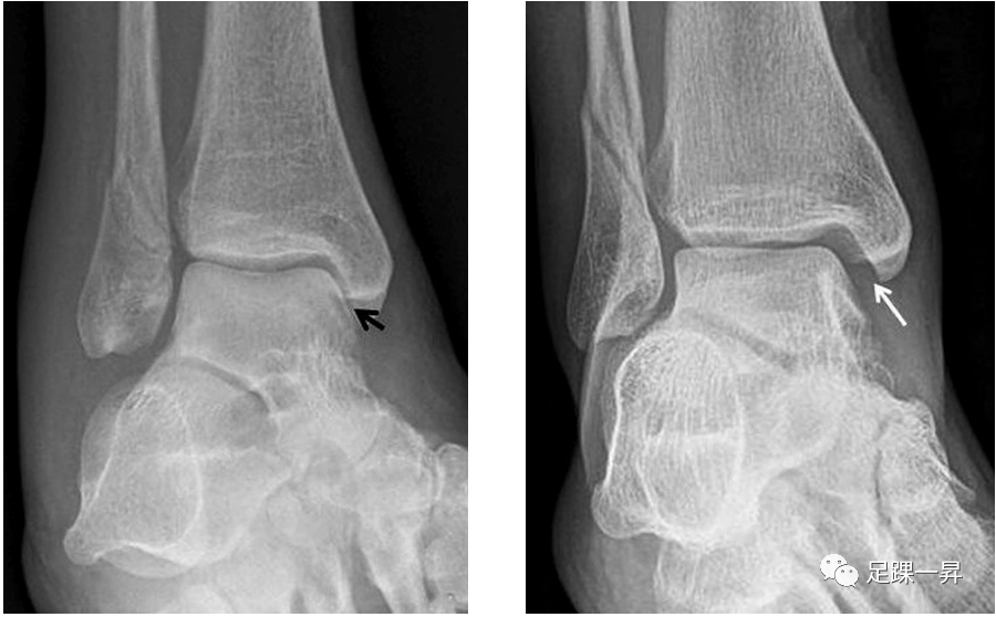 踝关节骨折：三角韧带损伤对Weber B型踝关节骨折稳定性的影响- 好医术 