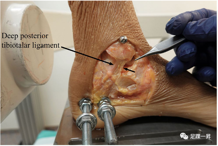 踝关节骨折：三角韧带损伤对Weber B型踝关节骨折稳定性的影响- 好医术 