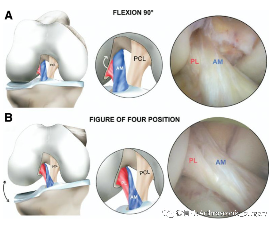【手术技术】前交叉韧带（ACL）囊肿切除技巧分享