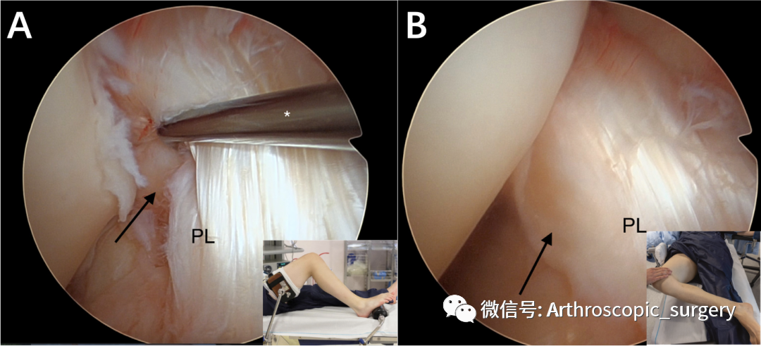 【手术技术】前交叉韧带（ACL）囊肿切除技巧分享